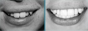 Sutability for veneers