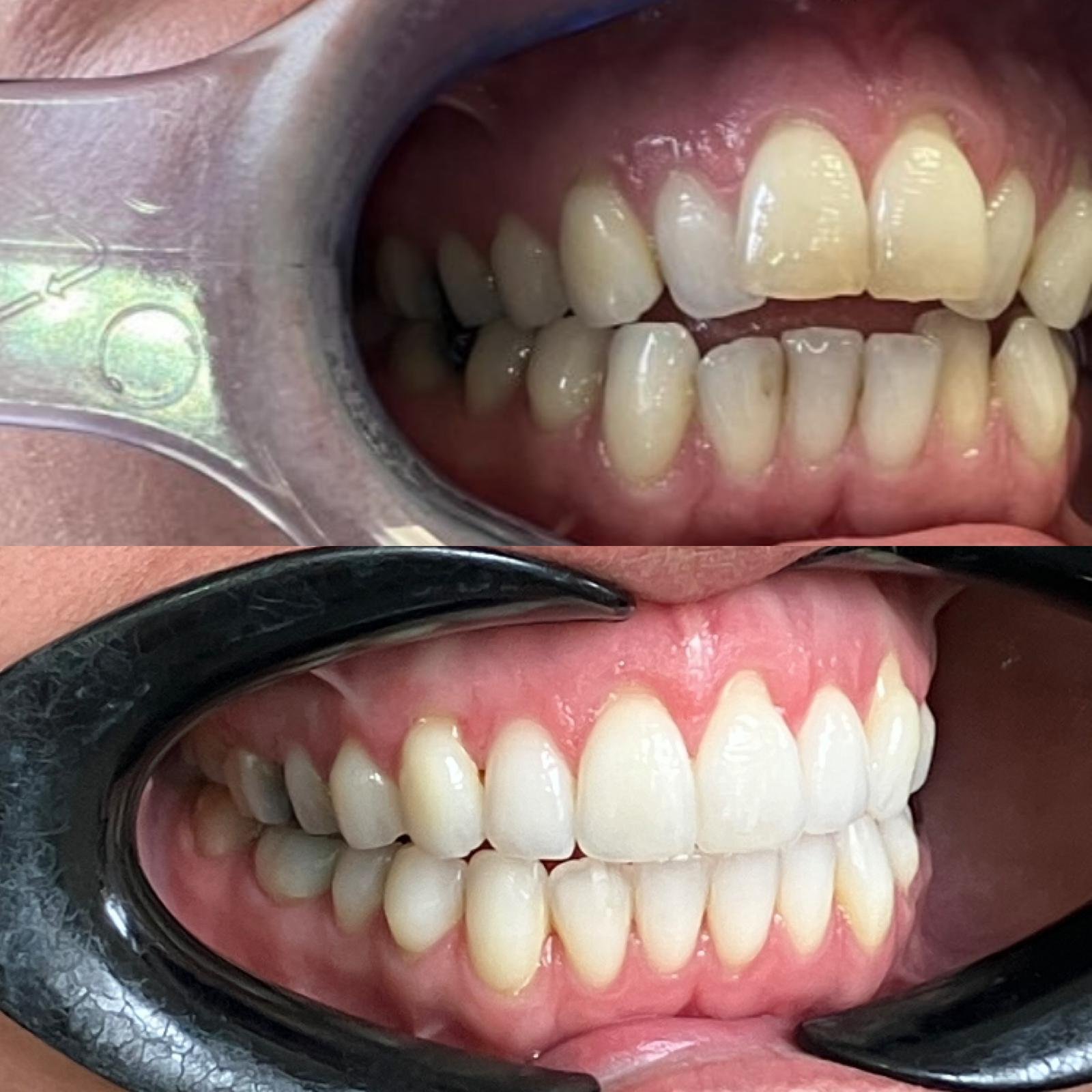 Invisalign Droitwich - before and after case photo 1