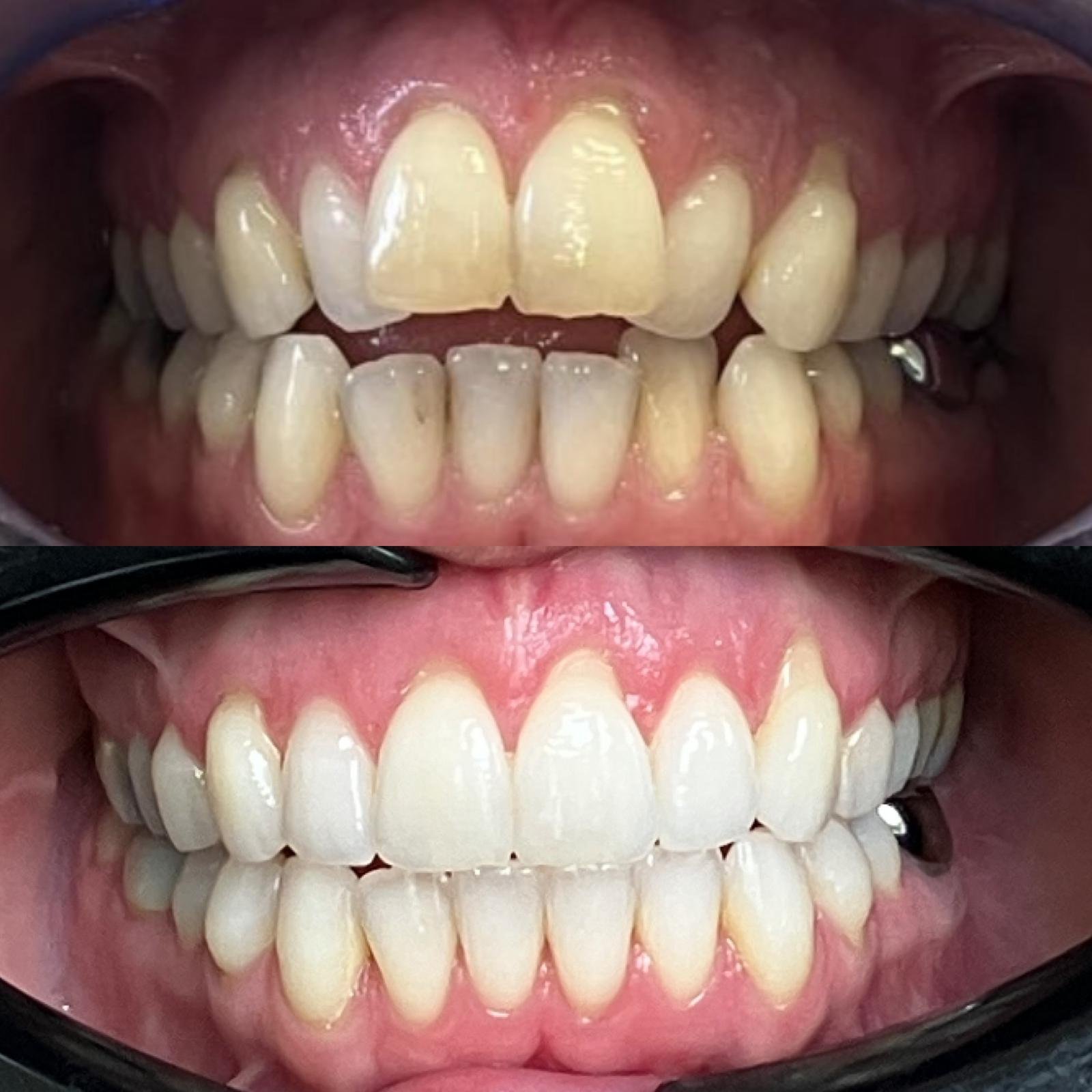 Invisalign Droitwich - before and after case photo 2