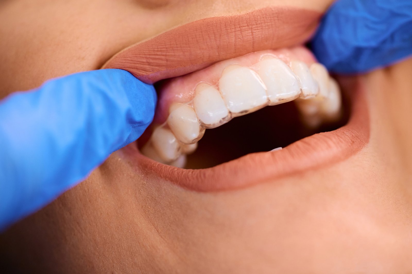 Coffee stains on teeth: why they happen and what actually removes them