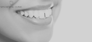 What Is an Overbite and How Can You Fix It?
