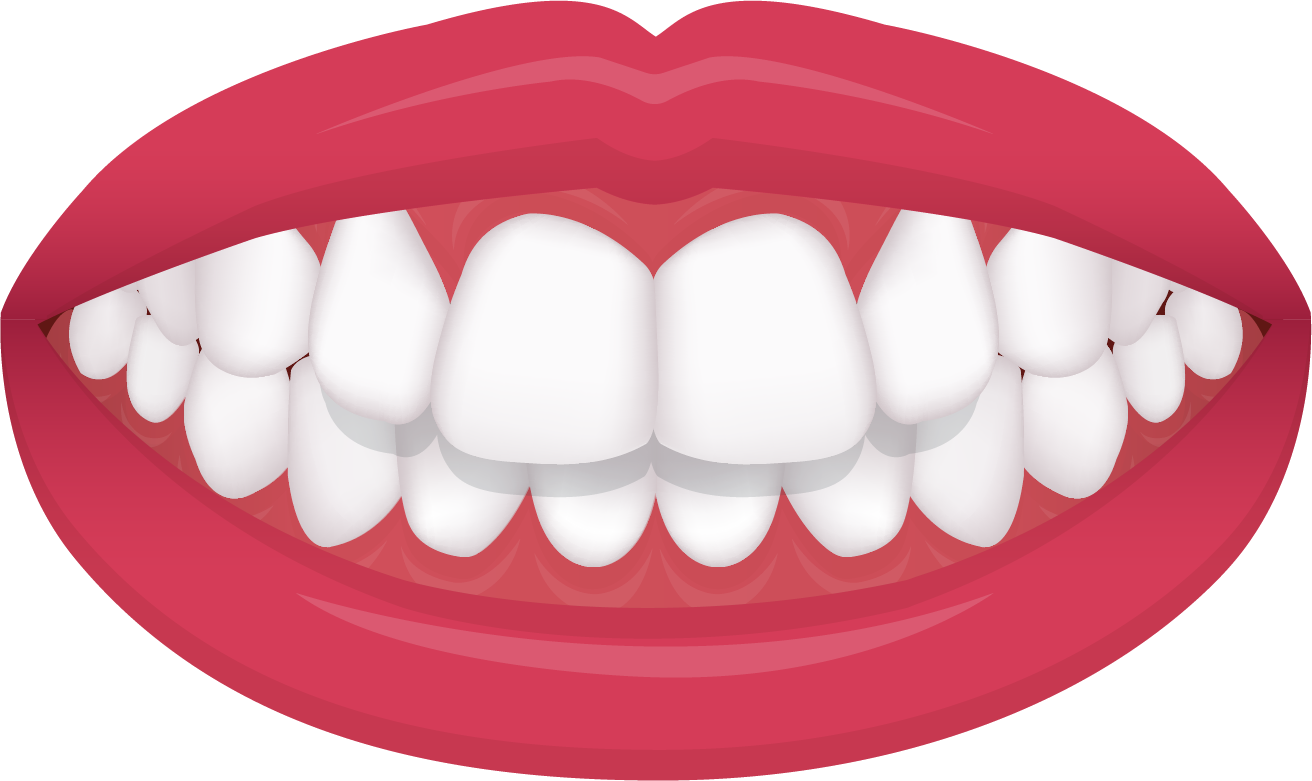 overbite overbite