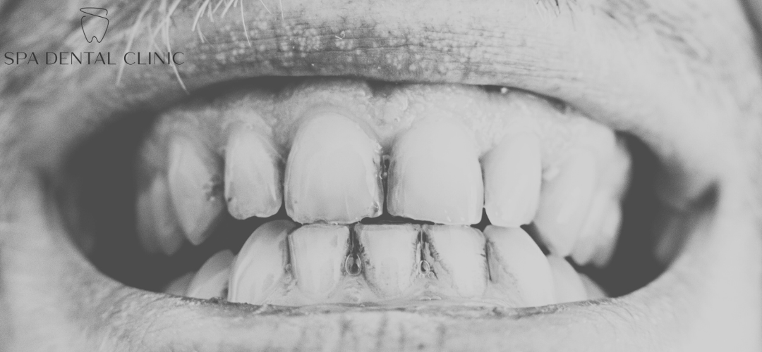 How to Treat and Prevent Stained Teeth: A Complete Guide