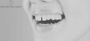 Gaps Between Teeth: Causes & Options