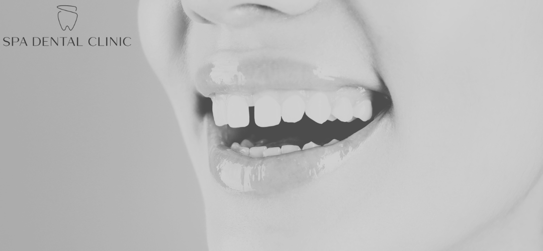 gaps between teeth - spa dental clinic gaps between teeth - spa dental clinic