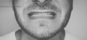 Underbite vs Overbite: what’s the difference