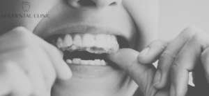 How to Straighten Teeth Without Braces