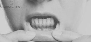 Why Are My Gums Swelling?